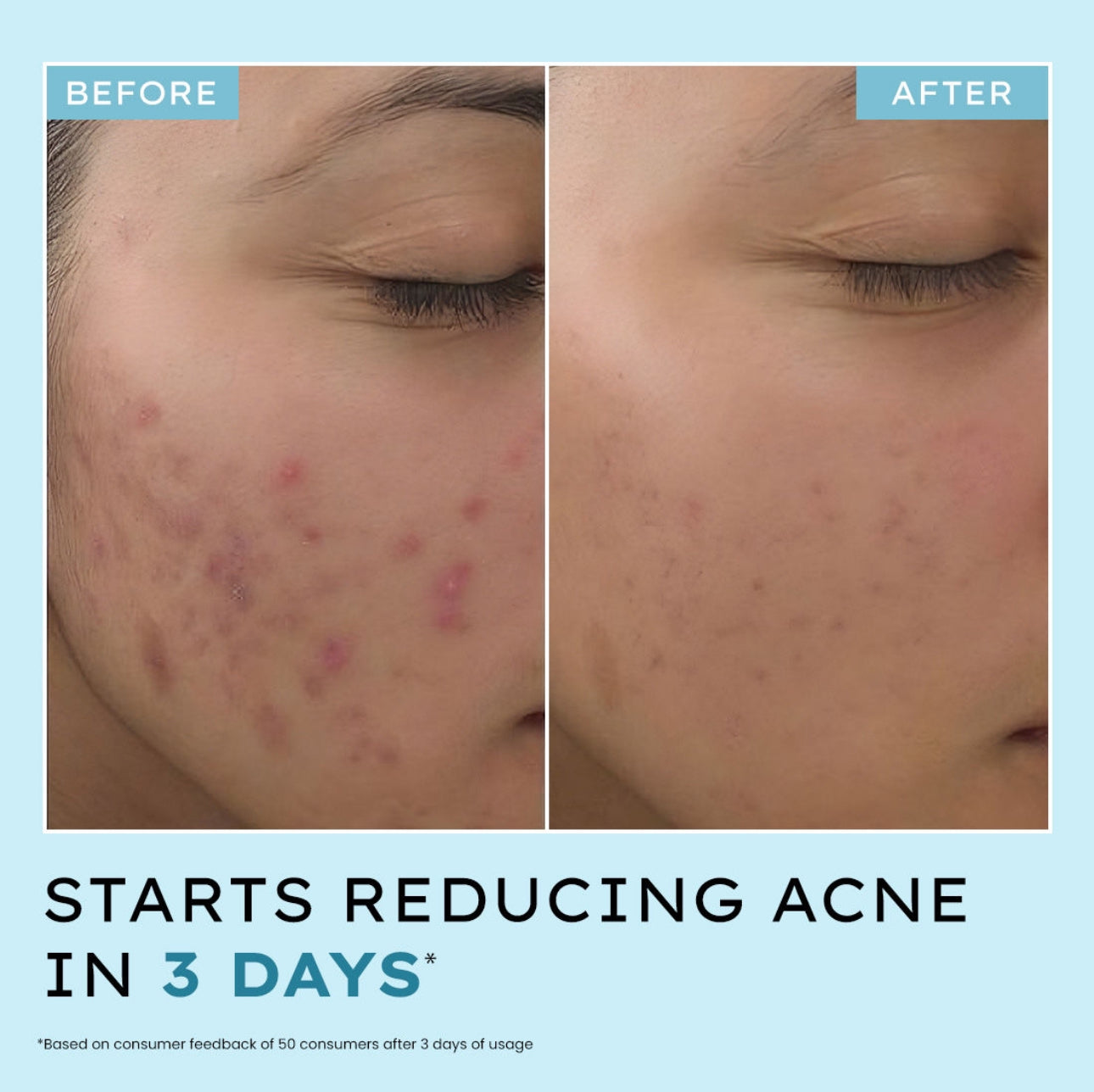 Acne Defence Daily Serum